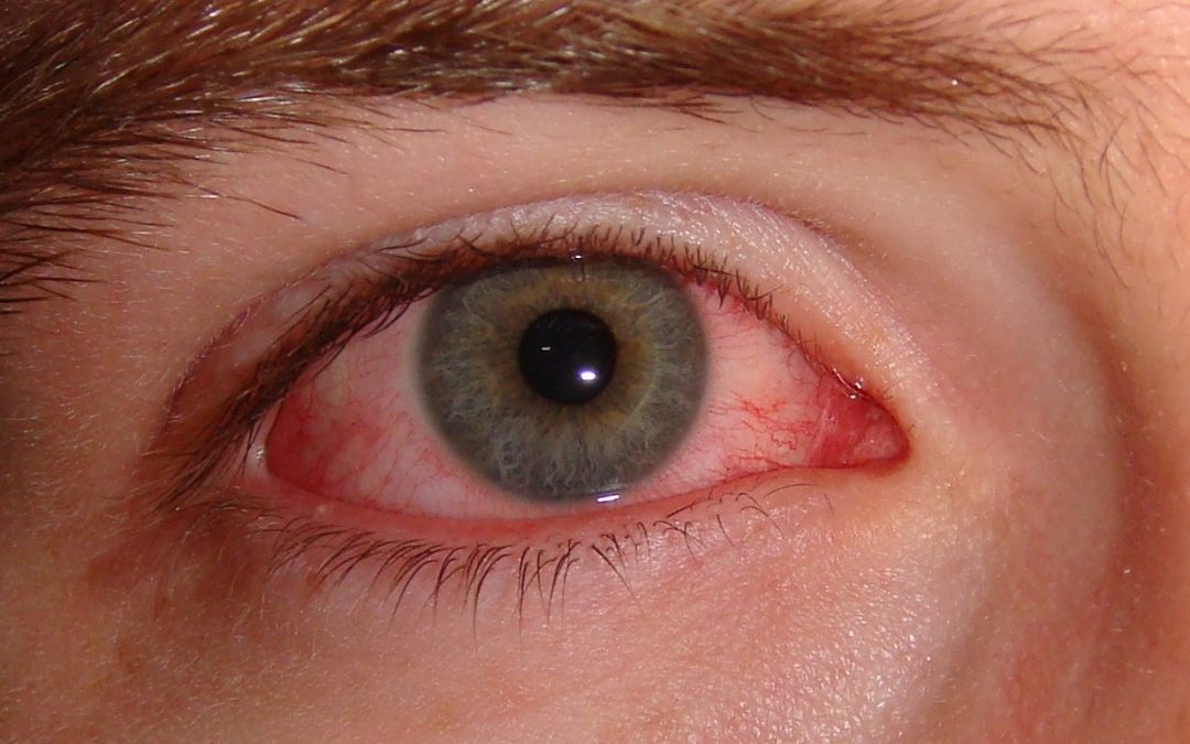 The Many Causes of a Red Eye