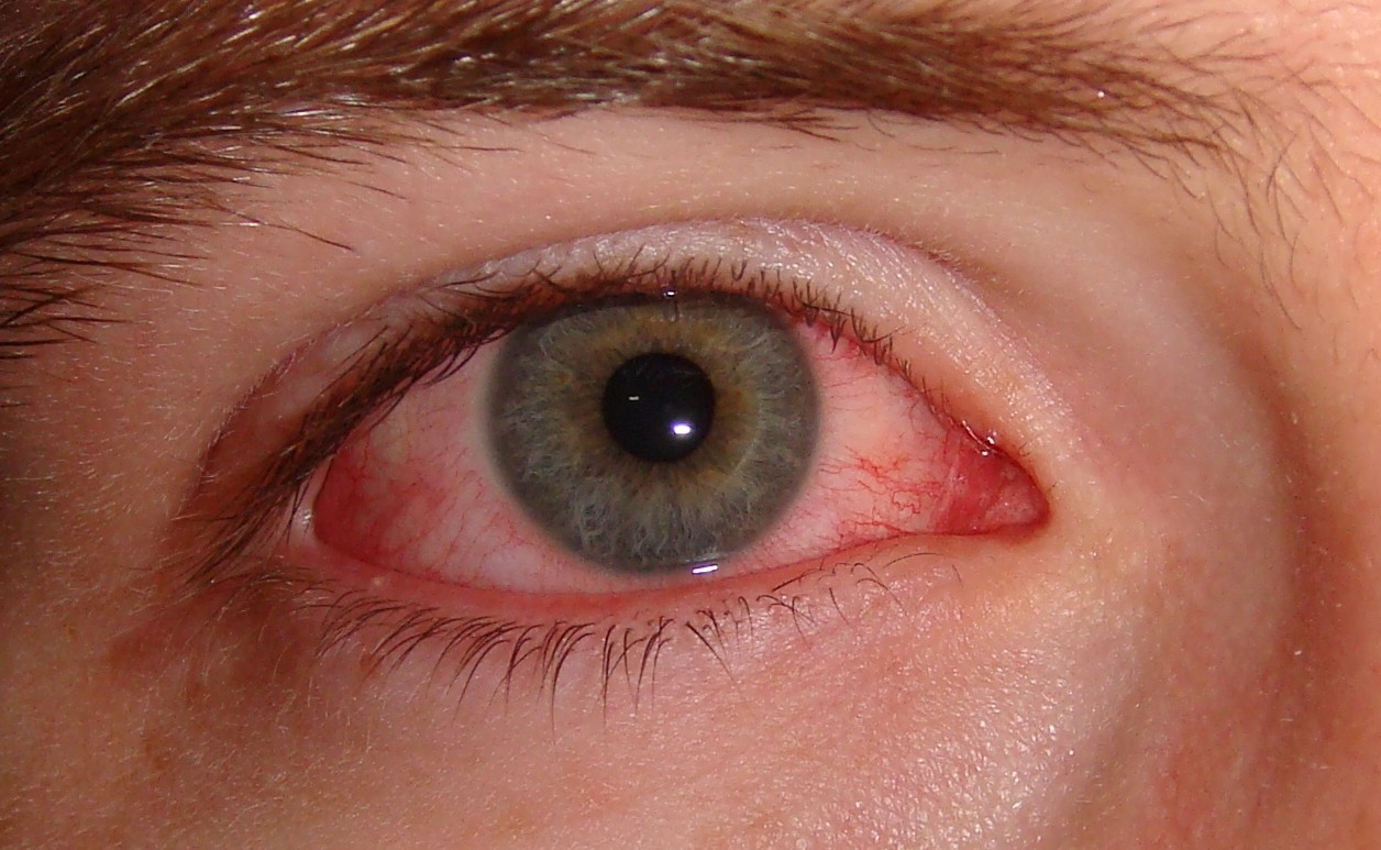 flare Sæbe Savant The Many Causes of a Red Eye | Wilmington Family Eye Care