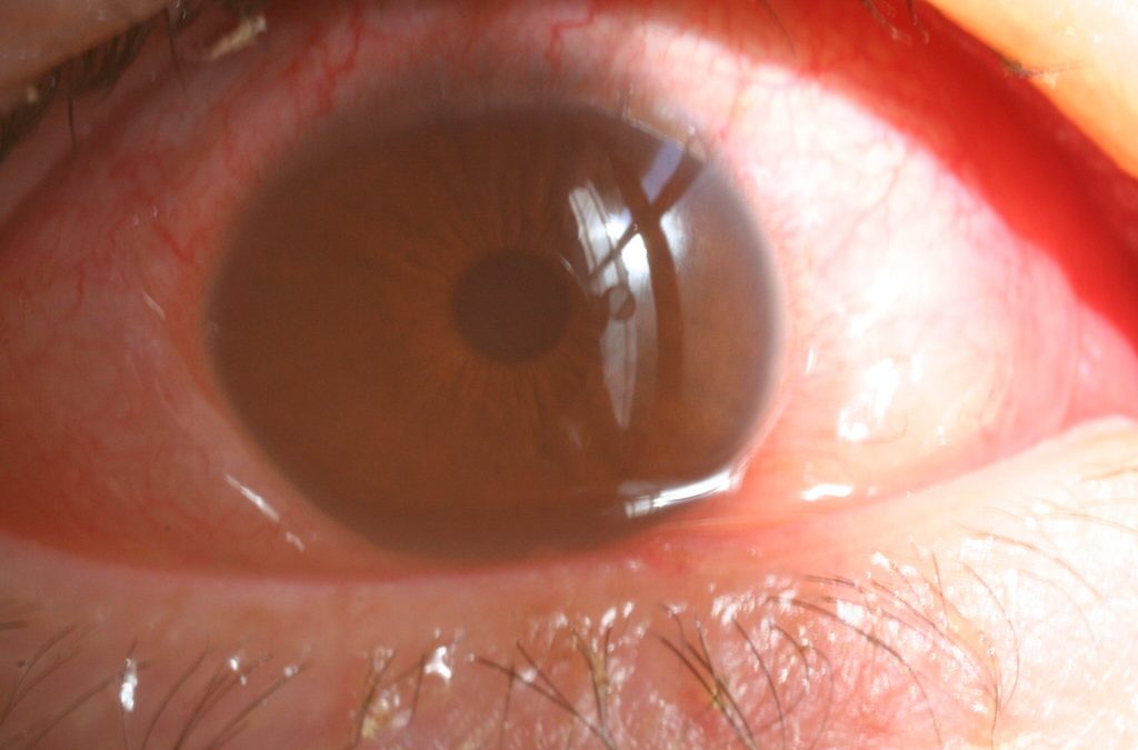 What is the Difference Between Eye Allergies and Conjunctivitis