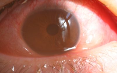 What is the Difference Between Eye Allergies and Conjunctivitis