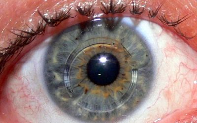 Are Keratoconus and Myopia Connected?