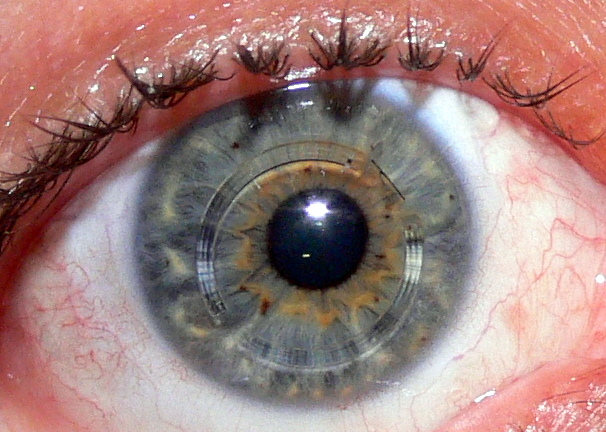 Are Keratoconus and Myopia Connected?
