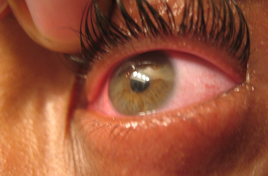 What Does a Scratch on the Eye Feel Like?