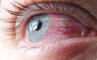 What is the Difference Between an Eye Infection and Allergies?