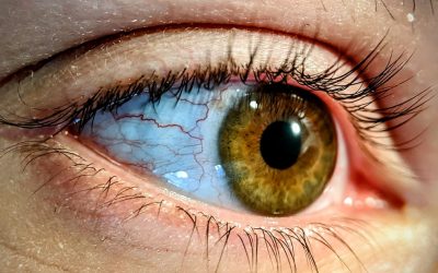 Contact Lens Care Mistakes to Avoid